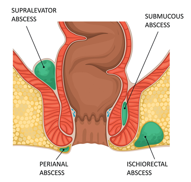 Haemorrhoids (Piles) Doctor in Mumbai | Comprehensive Information on  Symptoms & Treatments